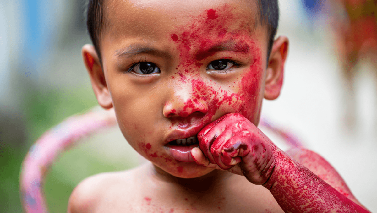 What are measles symptoms? Is it contagious? Here's what to know.healthcare